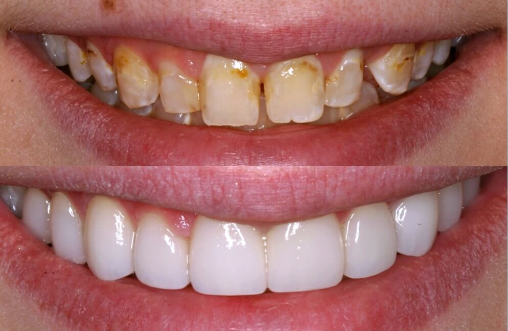 Porcelain Veneers For Front Teeth